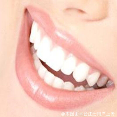烤瓷牙的种类有哪些？烤瓷牙的使用寿命是多久？